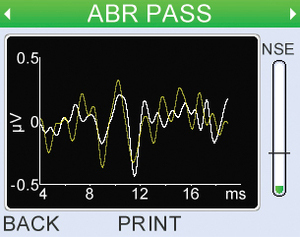 The Otoport ABR continually monitors Fsp and ABR waveform shape to ensure a ‘Clear Response’ is a true response.