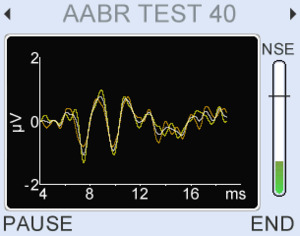 Real time ABR waveform view available when AABR on the Otoport Pro Clinical and Advanced Clinical. Advanced Clinical Extendable FSP for AABR waveform capture